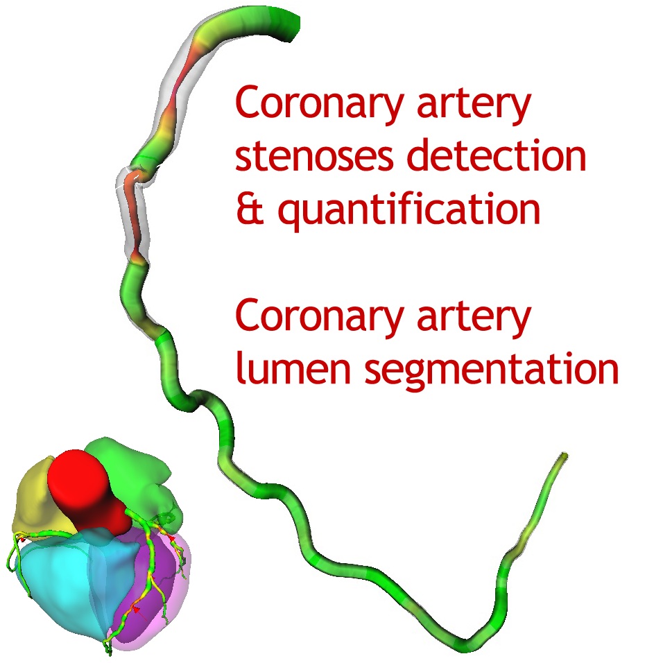 Coronary stenosis visualization from the previous website